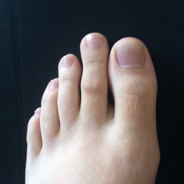 Morton’s toe